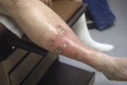 Guideline: Prescribing for leg ulcers