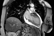 Cardiovascular clinic: Pericarditis