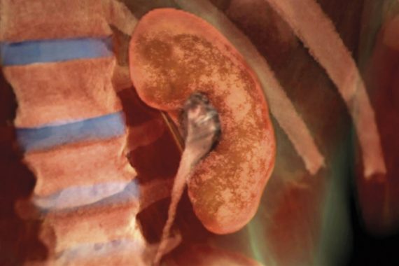 Key questions on chronic kidney disease