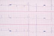 CV clinic – Short QT Syndrome