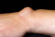 Symptom sorter – Hand and wrist swellings