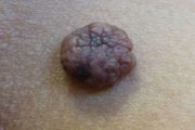 CPD: Transferring skin lesion images