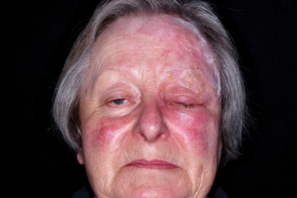 Shingles