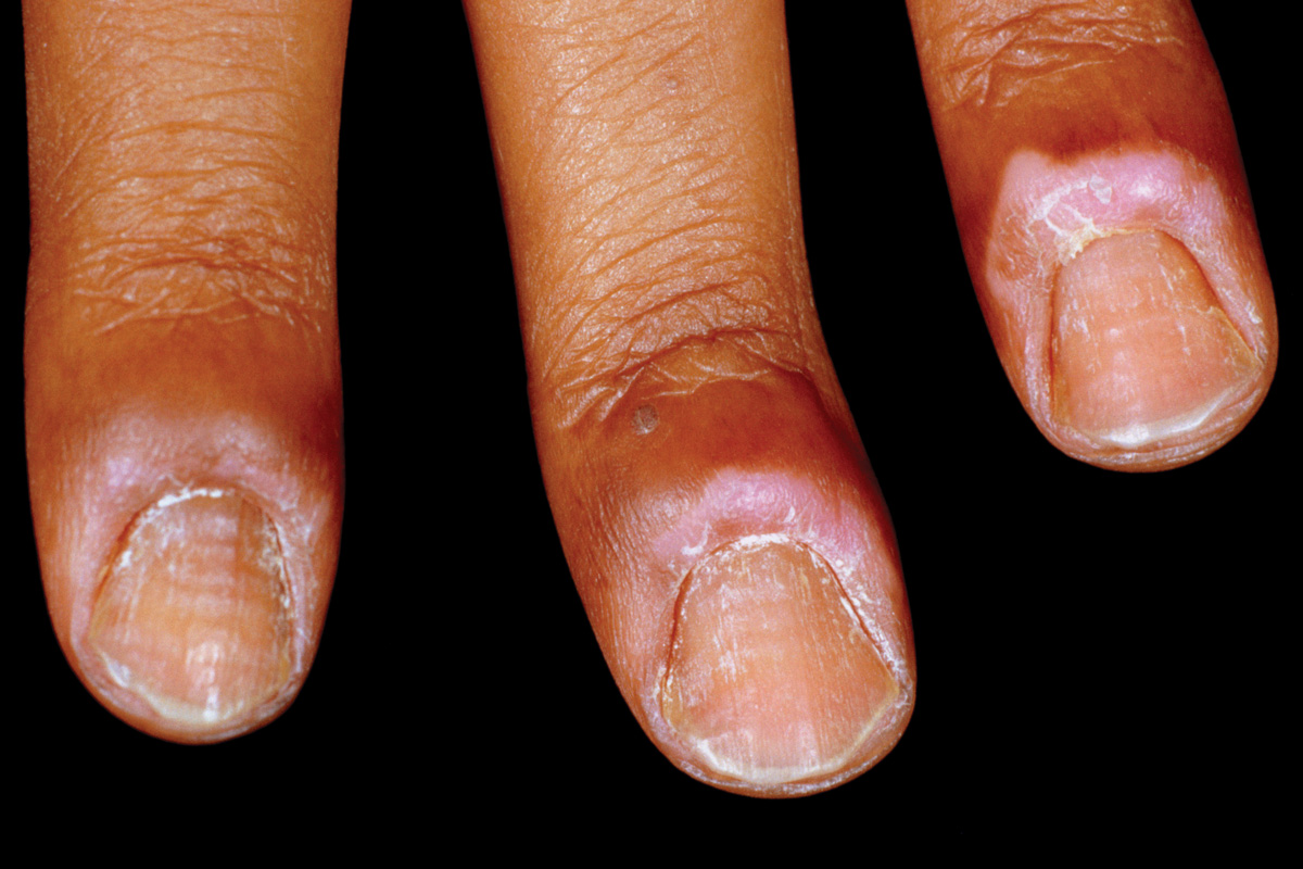 Nails infection in children – DoktorBudak