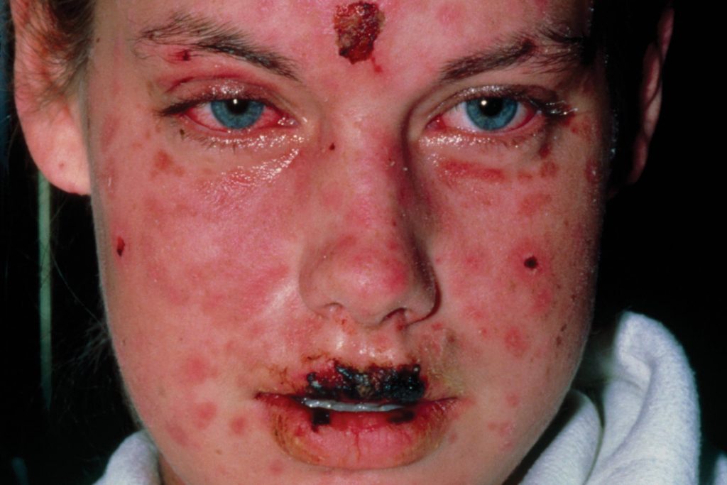 Stevens-Johnson syndrome