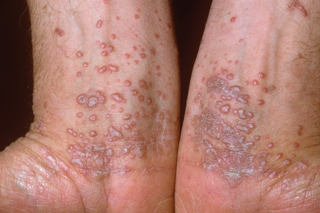 Lichen planus