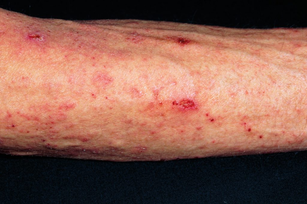 Scabies skin infection