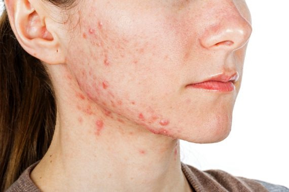 Spironolactone safe and effective in treating acne in women, study finds