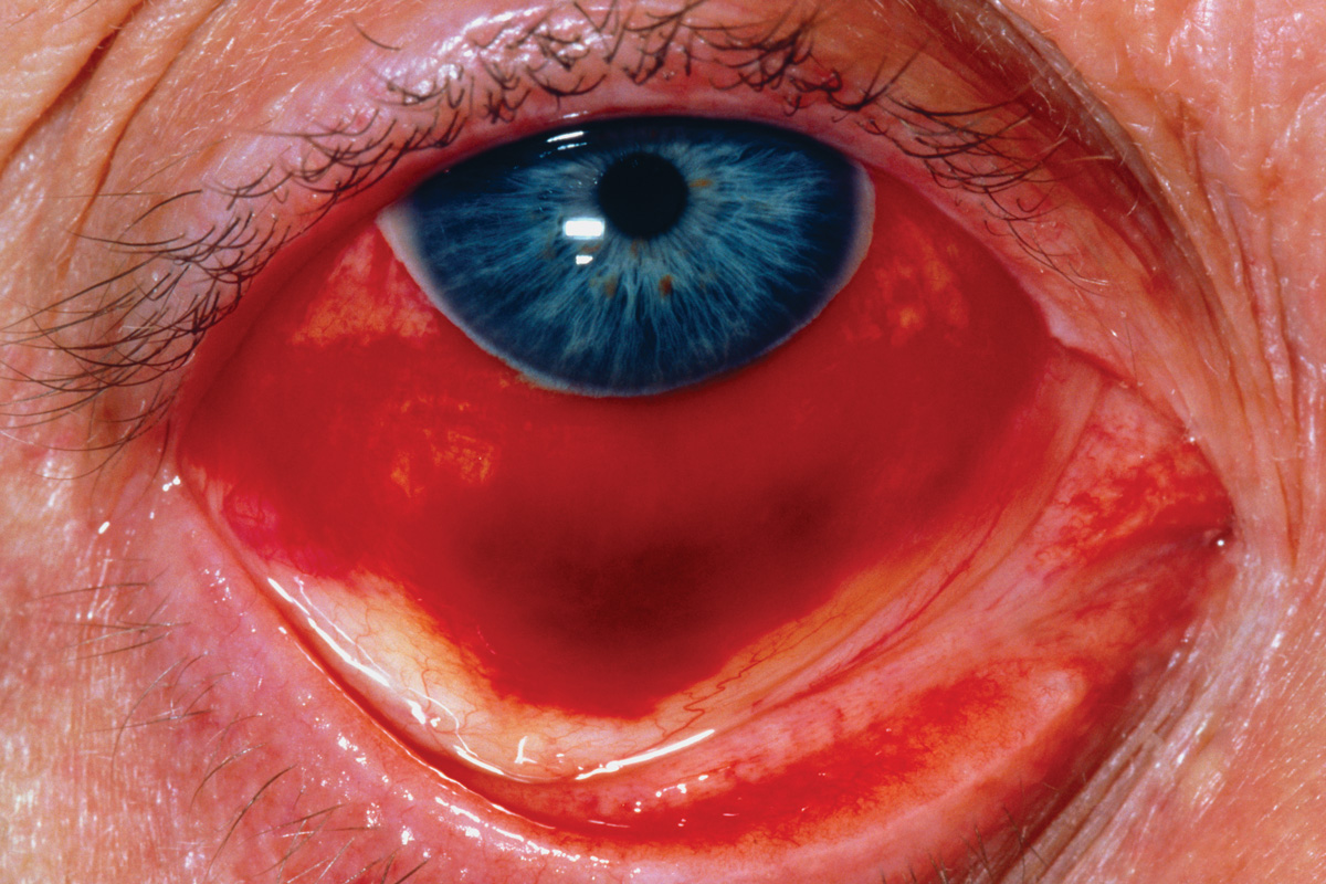 Medical arithmetic: bloodshot eyes, eczema, swallowing problems.