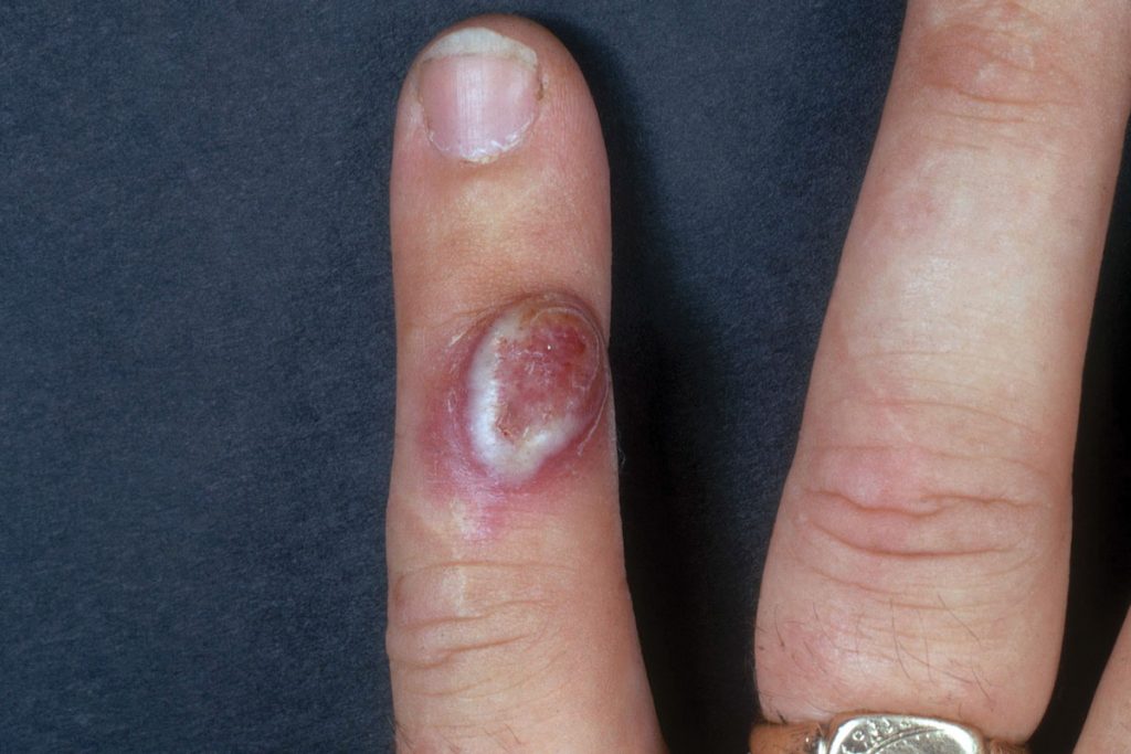 Orf disease, lesion on finger