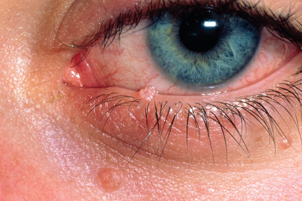 Molluscum contagiosum infection of lower eyelid