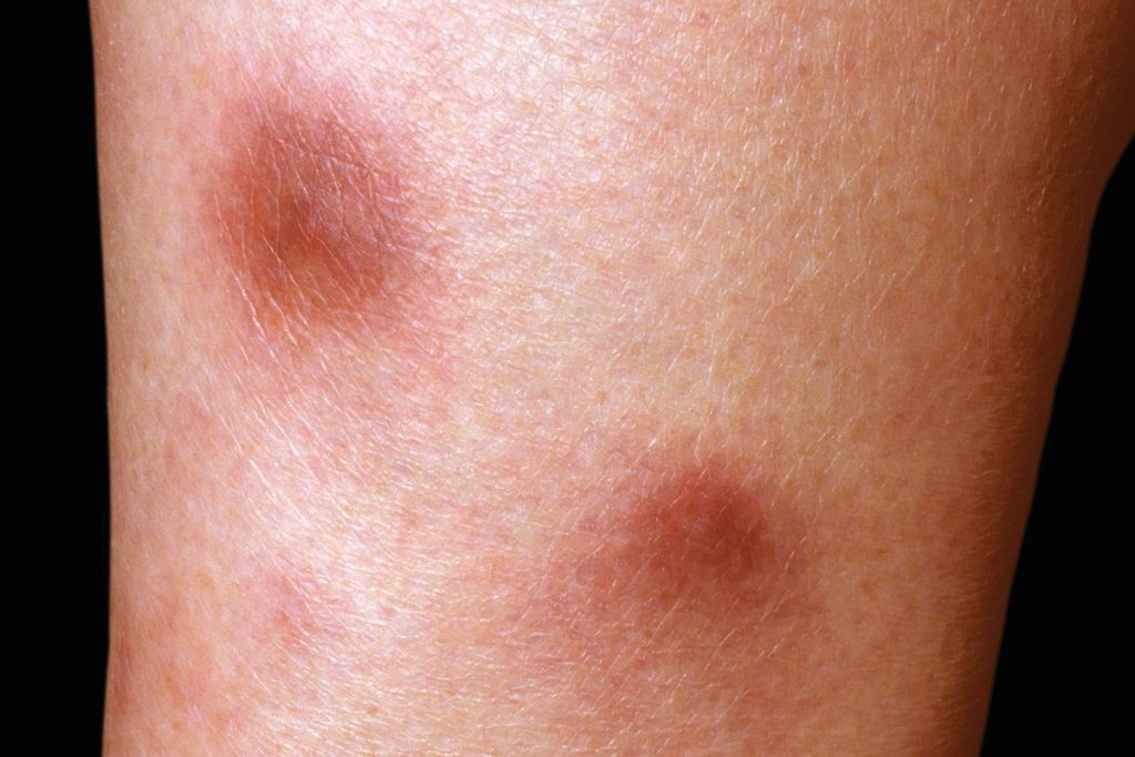 Erythema nodosum rash