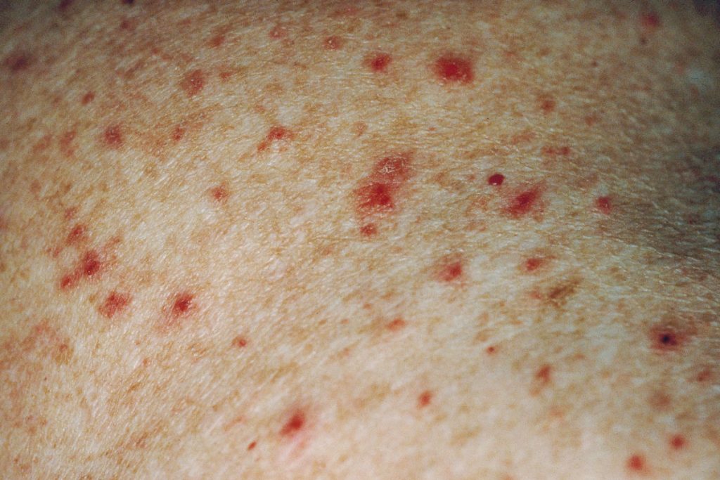 Hot Tub Folliculitis