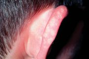 Medical arithmetic: unusual ear rash, leg bruises and shoulder pain