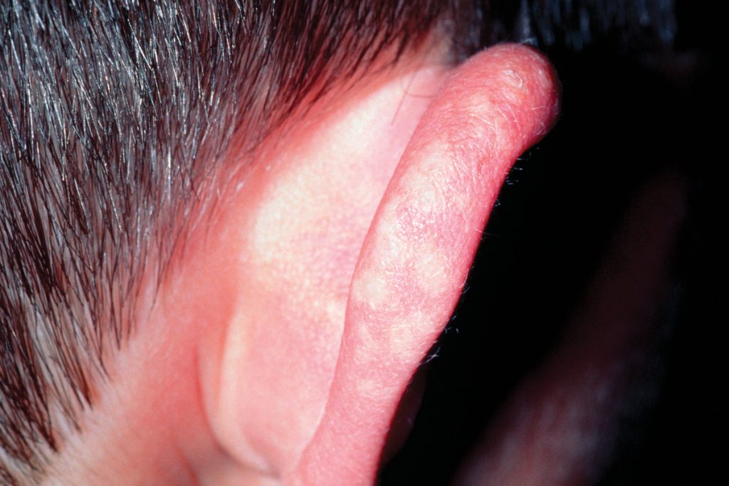 Juvenile spring eruption on boys ear