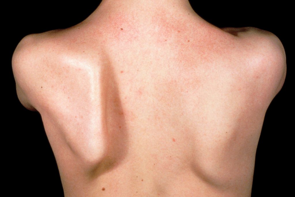 Patient with winged scapula