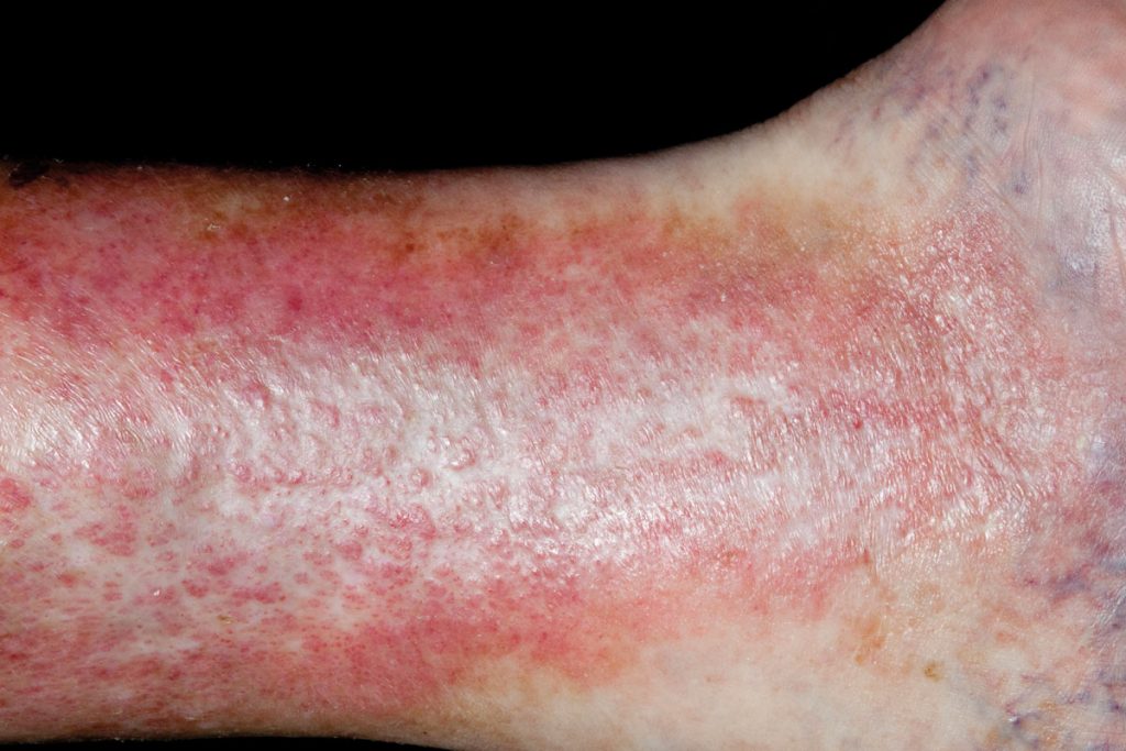 Treated varicose eczema