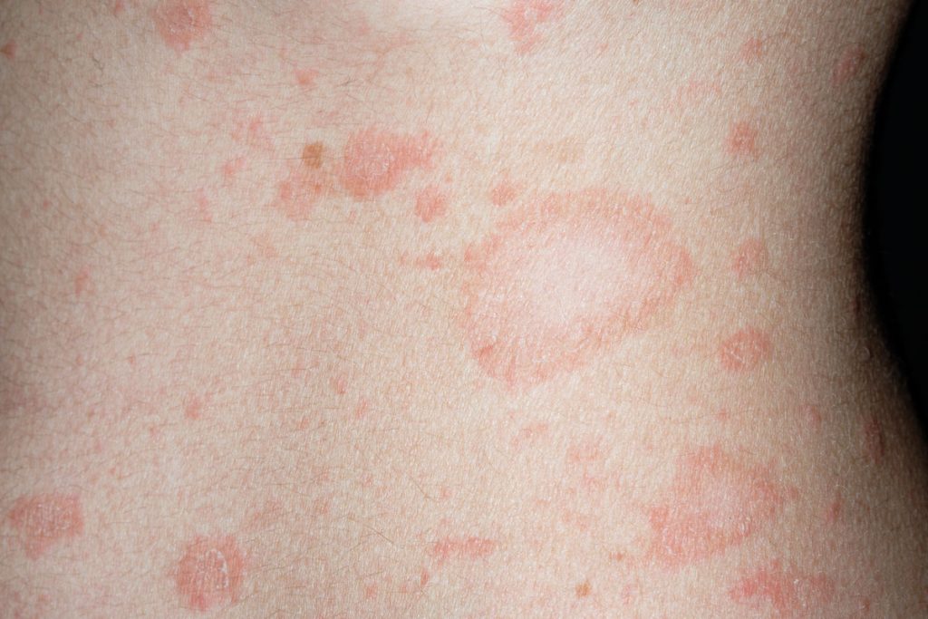 Pityriasis_rosea