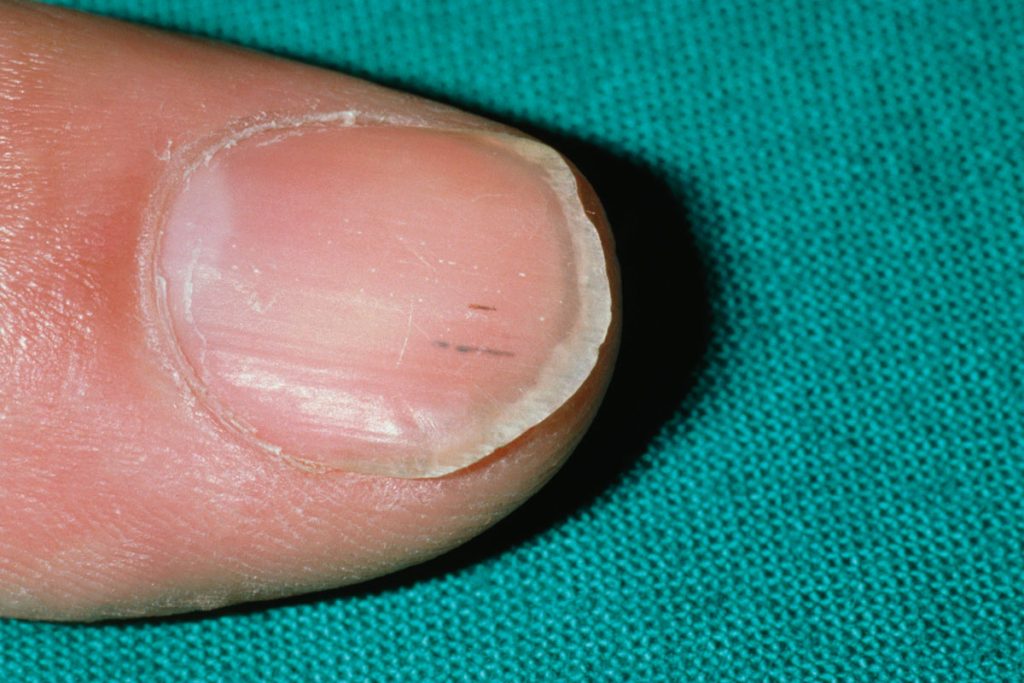 Splinter_haemorrhage_on_finger_nail_in_endocarditis