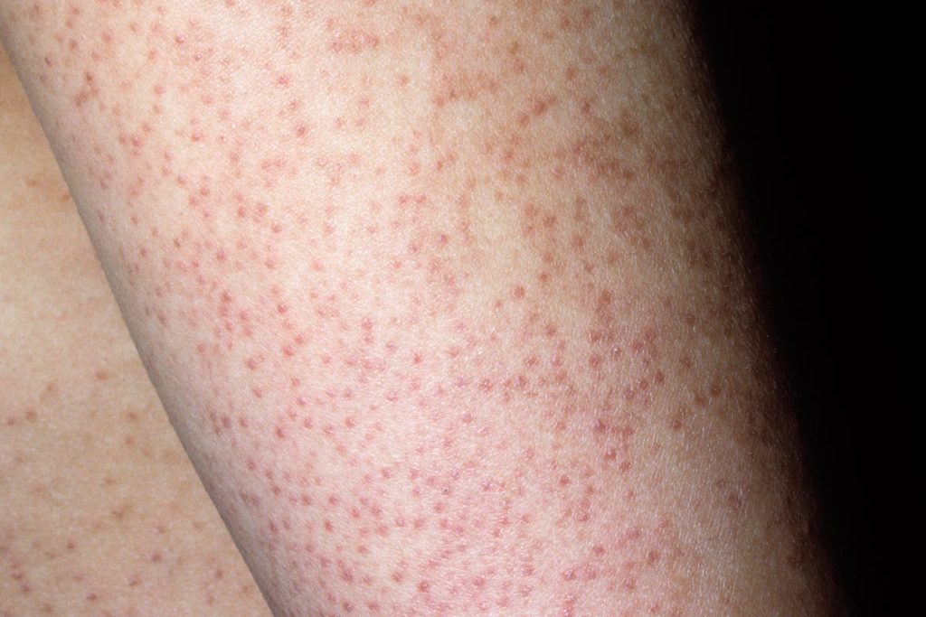 Keratosis_pilaris