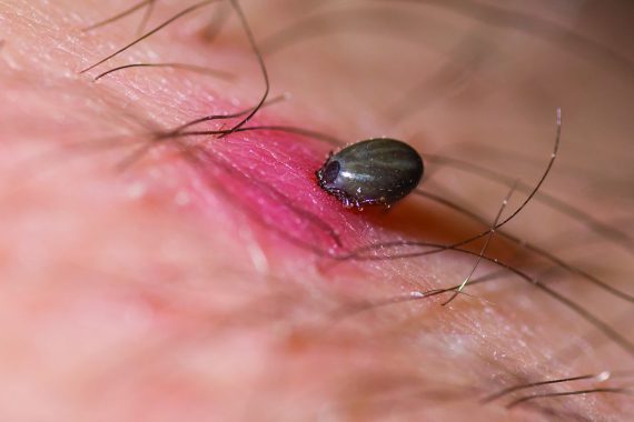 Tick-bite patients advised to see GP if unwell after TBE detected in UK