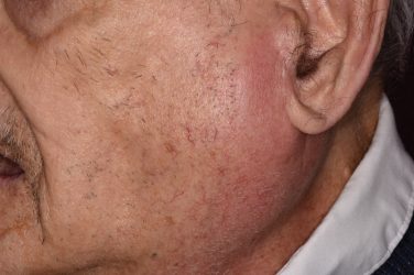 Medical arithmetic: Jaw swelling, persistent ‘thrush’ and sweat rash