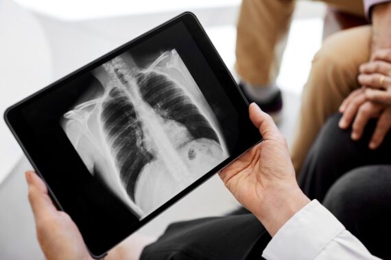 GPs to offer TB symptom screening to new Ukrainian patients over 11