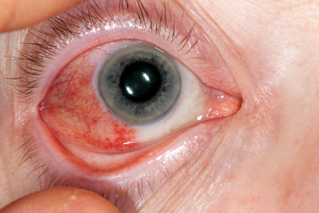 Episcleritis_of_the_eye
