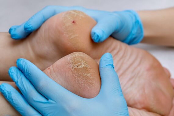 Diabetes patients ‘having to rely on GPs’ as specialist footcare access patchy, warns review