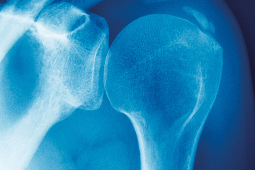 Calcifying_tendinitis_of_shoulder