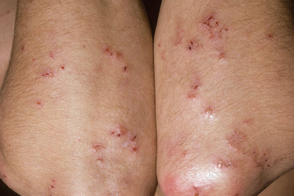 Dermatitis_herpetiformis