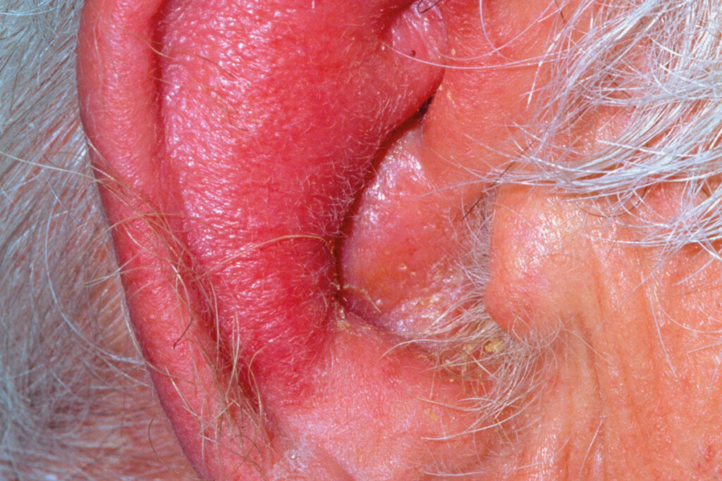 Inflamed_ear_of_elderly_man_with_perichondritis