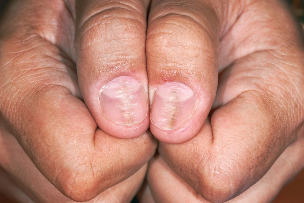 Nail Disorders Phoenix, AZ | Scottsdale Nail Disorders