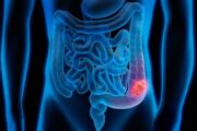 Guidelines update: use of FIT in colorectal cancer referrals