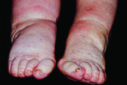 Clinical clanger: ‘My ankles are really swollen, doctor – can you give me some of those water tablets?’
