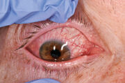 CPD: Key questions on acute red eye
