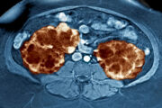 CPD: Key questions on polycystic kidney disease