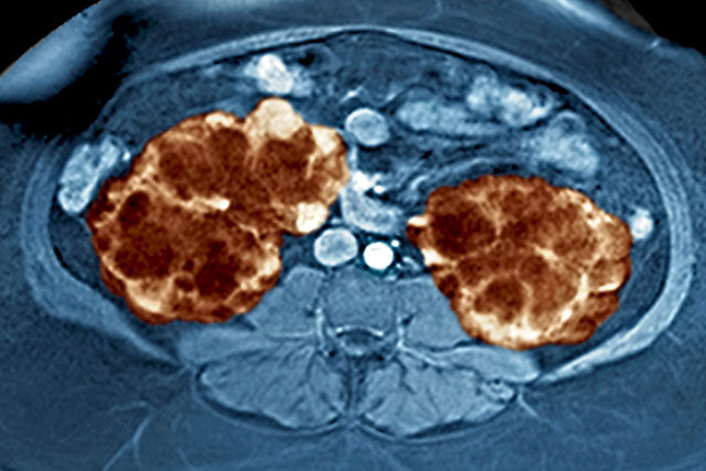 Adult polycystic kidney disease