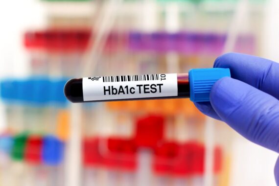 Diabetes screening through HbA1c tests could pick up cases two years earlier, study suggests