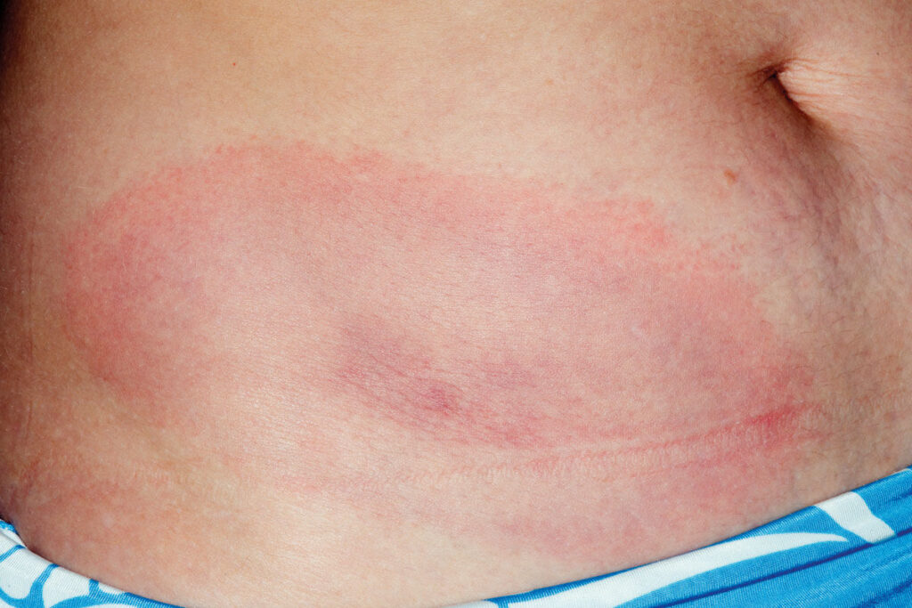 Erythema_migrans_rash_in_Lyme_disease