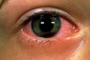 Medical arithmetic: skin rash, eye trauma and recurrent anaemia