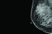 Overdiagnosis: Breast cancer screening