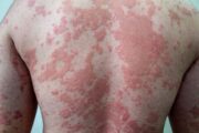 Top tips on psoriasis diagnosis and management