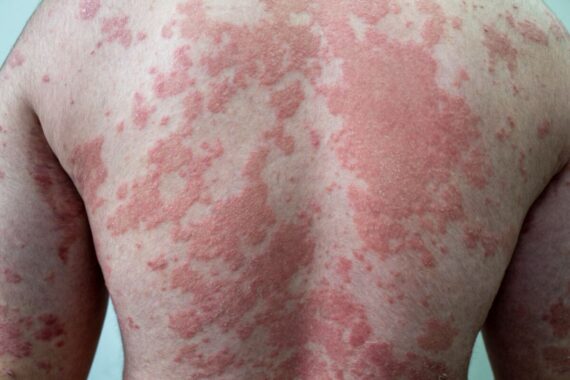 Top tips on psoriasis diagnosis and management