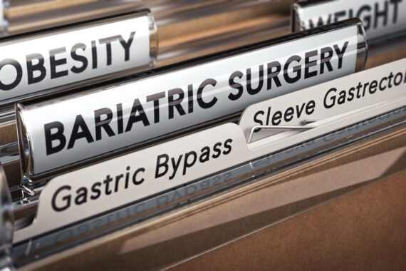 NICE draft guidance recommends endoscopic sleeve gastroplasty