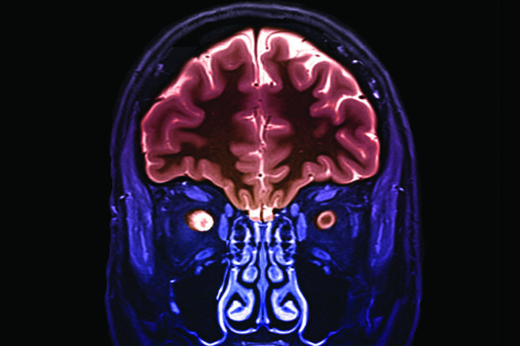 Key questions: Multiple sclerosis