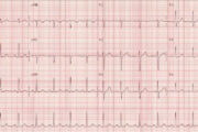 ECG quiz: Can you work out the heart rate from a printout?