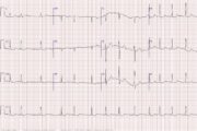 Stabbing pains and suspected heart failure: What could these ECGs mean?