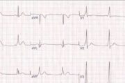 ECG quiz: What do these traces of palpitations indicate?
