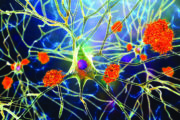 Key questions: Dementia